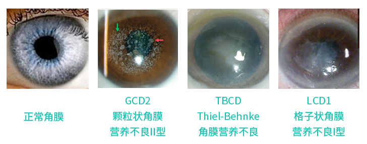 什么是角膜营养不良